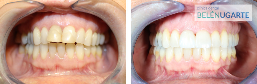 tratamiento de rehabilitación dental en la clinica dental belén ugarte en tolosa con carillas