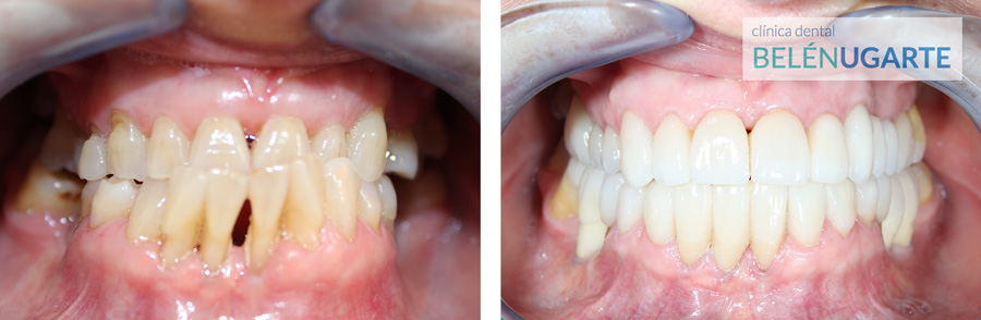 tratamiento de rehabilitación dental en la clinica dental belén ugarte en tolosa con carillas