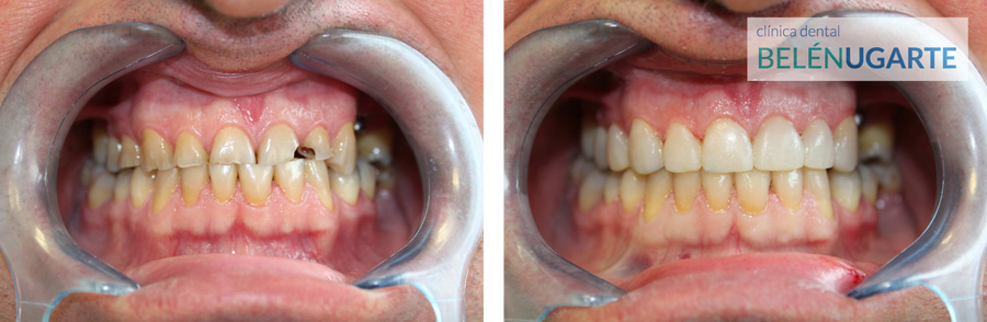 tratamiento de rehabilitación dental en tolosa