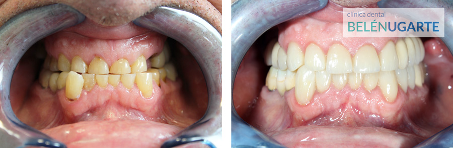 tratamiento de rehabilitación dental en la clinica dental belén ugarte en tolosa con carillas, coronas e implantes