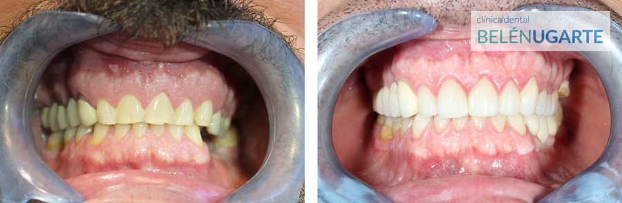 tratamiento de rehabilitación dental en la clinica dental belén ugarte en tolosa con carillas, coronas e implantes