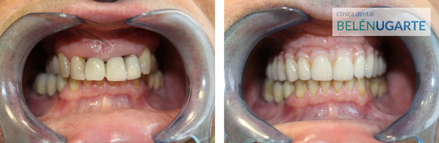 tratamiento implantes dentales en tolosa