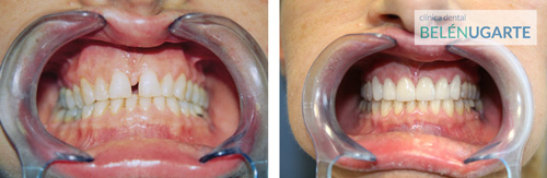 Tratamiento de ortodoncia en tolosa