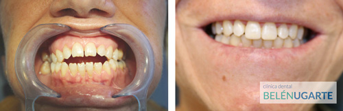 Tratamiento de ortodoncia en tolosa